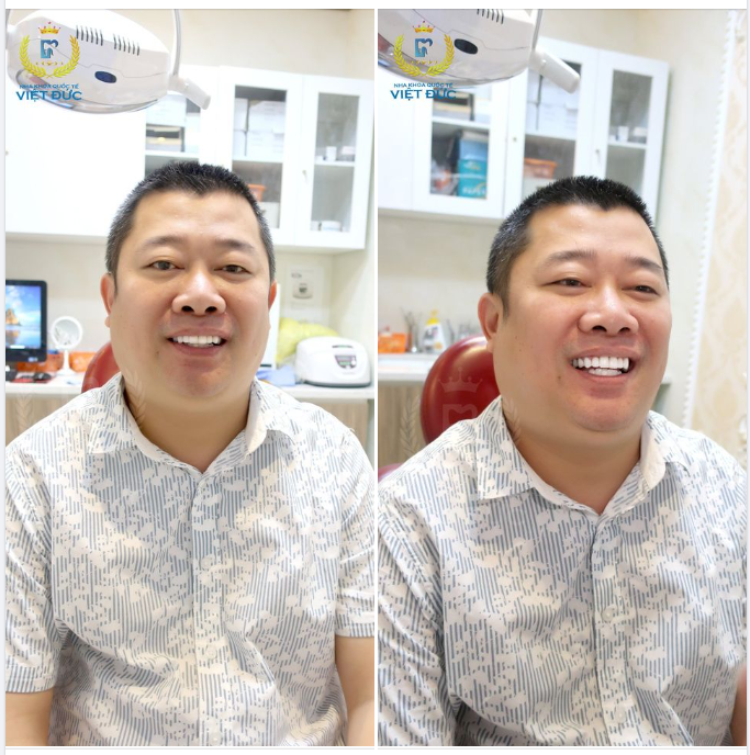 BẮT TRỌN KHOẢNH KHẮC NỤ CƯỜI RẠNG RỠ CỦA KHÁCH HÀNG KHI VỪA BỌC RĂNG SỨ