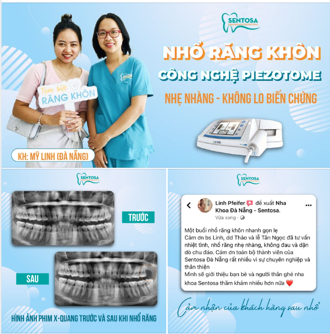 BÍ QUYẾT GÌ KHIẾN NHỔ RĂNG KHÔN TẠI NHA KHOA SENTOSA LẠI NHANH, GỌN, NHẸ NHƯ VẬY?