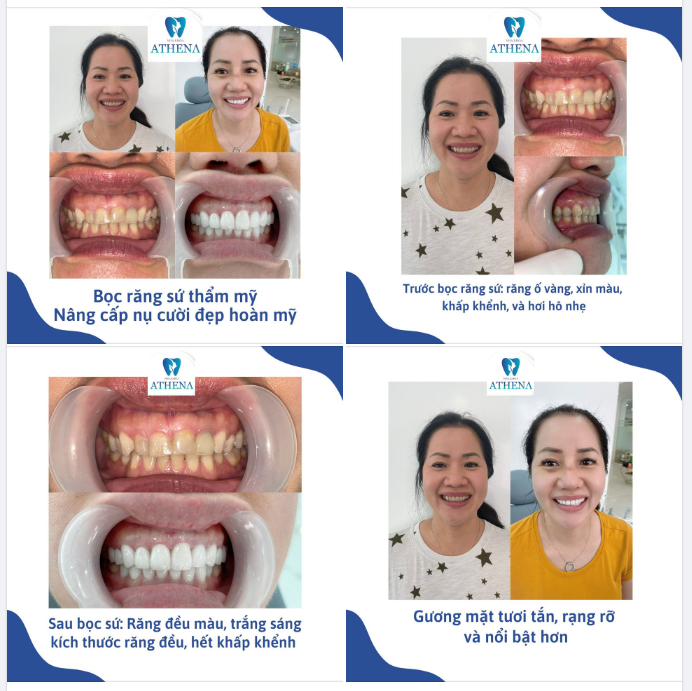 "Biết đẹp và nhanh thế, chị đã đi bọc sứ từ lâu lắm rồi. Nhưng thôi, giờ vẫn kịp đẹp em nhỉ?"