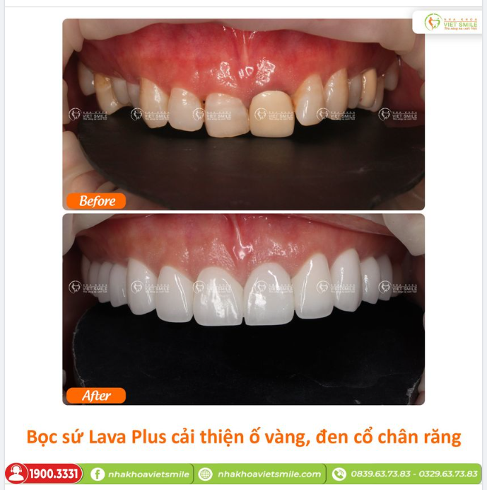 BỌC SỨ LAVA PLUS CẢI THIỆN Ố VÀNG, ĐEN CỔ CHÂN RĂNG