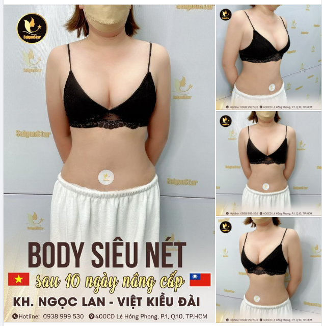 BODY “SIÊU NÉT” SAU 10 NGÀY NÂNG CẤP COMBO NÂNG VÒNG 1 + HÚT MỠ TOÀN BỤNG