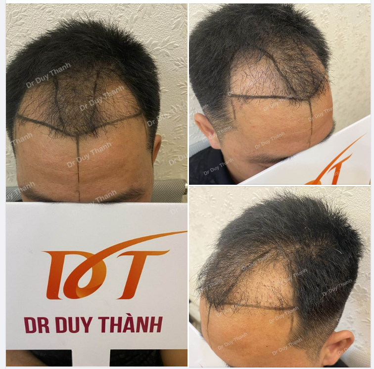 BOY ĐỒNG NAI 30 TUỔI CHUẨN BỊ CẤY 1500 NANG TÓC TRỊ HÓI CHỮ M