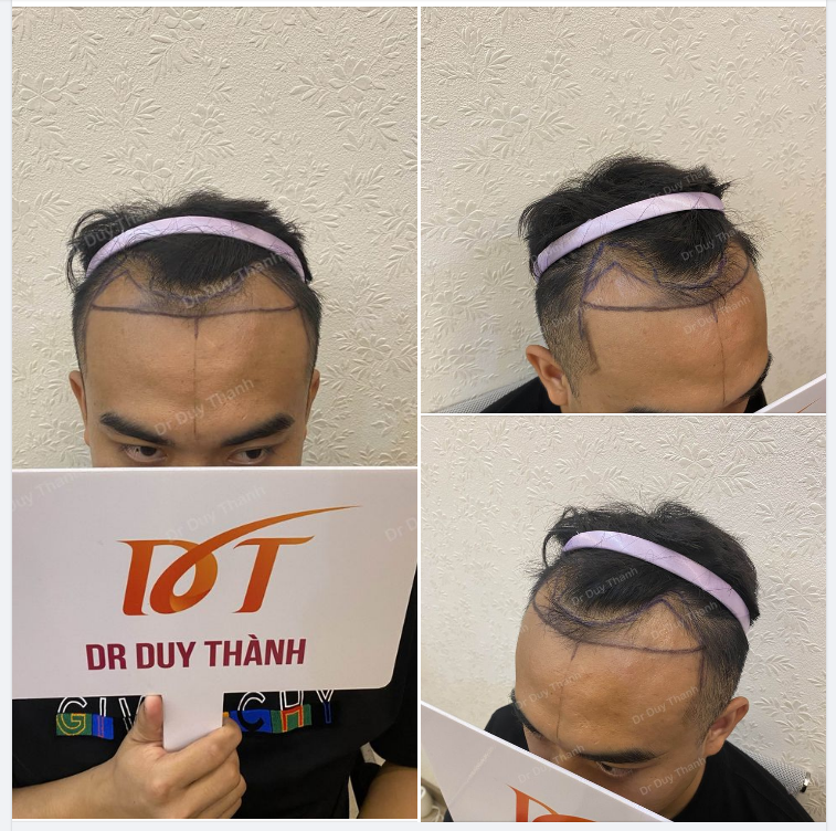 BOY HÀ NỘI CHUẨN BỊ CẤY 1500 NANG TÓC KHẮC PHỤC HÓI CHỮ M