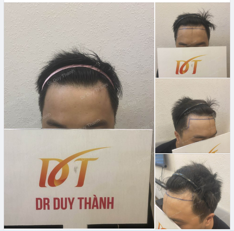 BOY TP.HCM 34 TUỔI CHUẨN BỊ CẤY TÓC 1500 NANG HẠ THẤP ĐƯỜNG CHÂN TÓC.