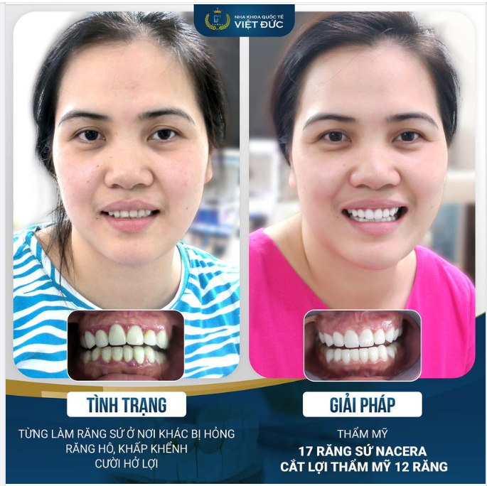 BUỒN VÌ TỪNG LÀM RĂNG SỨ BỊ HỎNG, KHÁCH HÀNG TÌM LẠI NỤ CƯỜI MỚI ĐẦY TỰ TIN