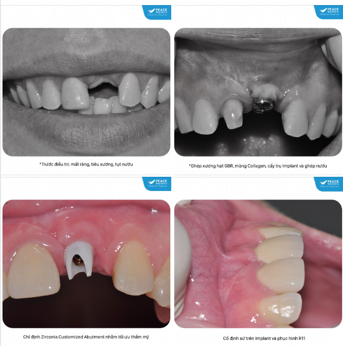 Ca lâm sàng - cấy ghép Implant -   ghép xương và  ghép nướu cho trường hợp mất răng cửa nhiều năm