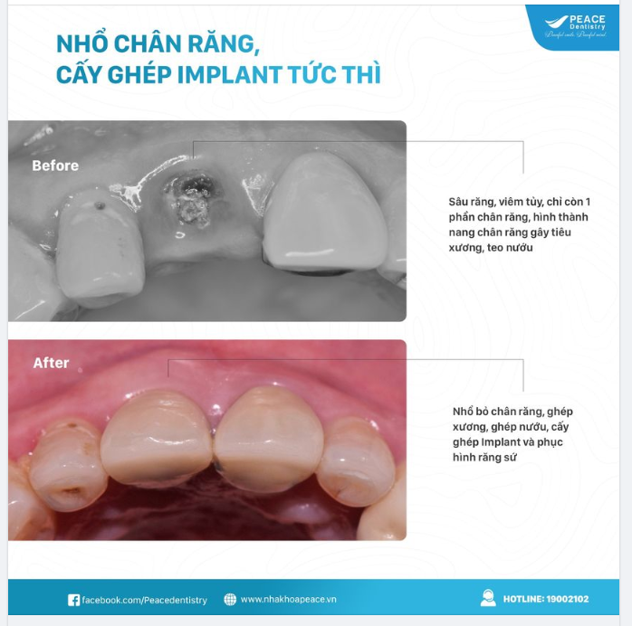 Ca lâm sàng - nhổ chân răng,  cấy implant tức thì,  ghép xương,  ghép nướu