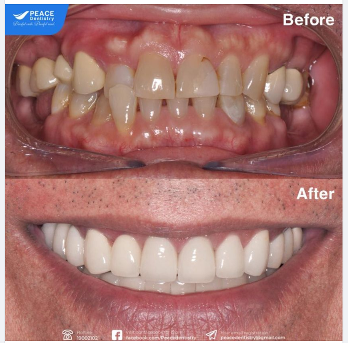 Ca lâm sàng - trồng răng Implant và  thẩm mỹ răng sứ giúp khôi phục toàn vẹn cả chức năng ăn nhai và thẩm mỹ nụ cười