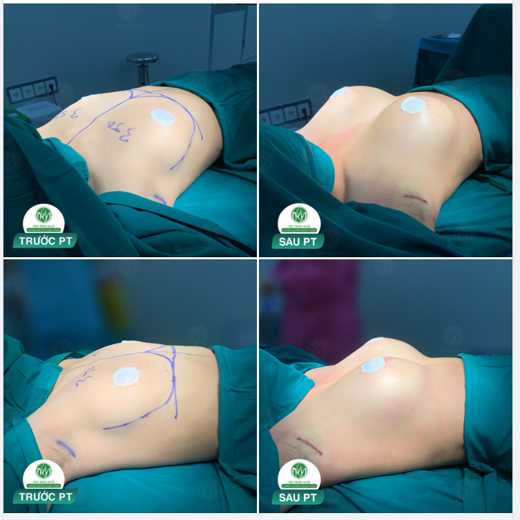 CA NÂNG NGỰC ĐƯỜNG NÁCH CHO KH 23 TUỔI