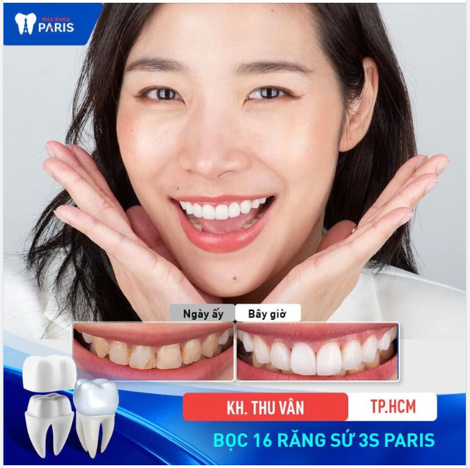 Ca răng sứ nóng hổi, vừa thổi vừa xem đây!!