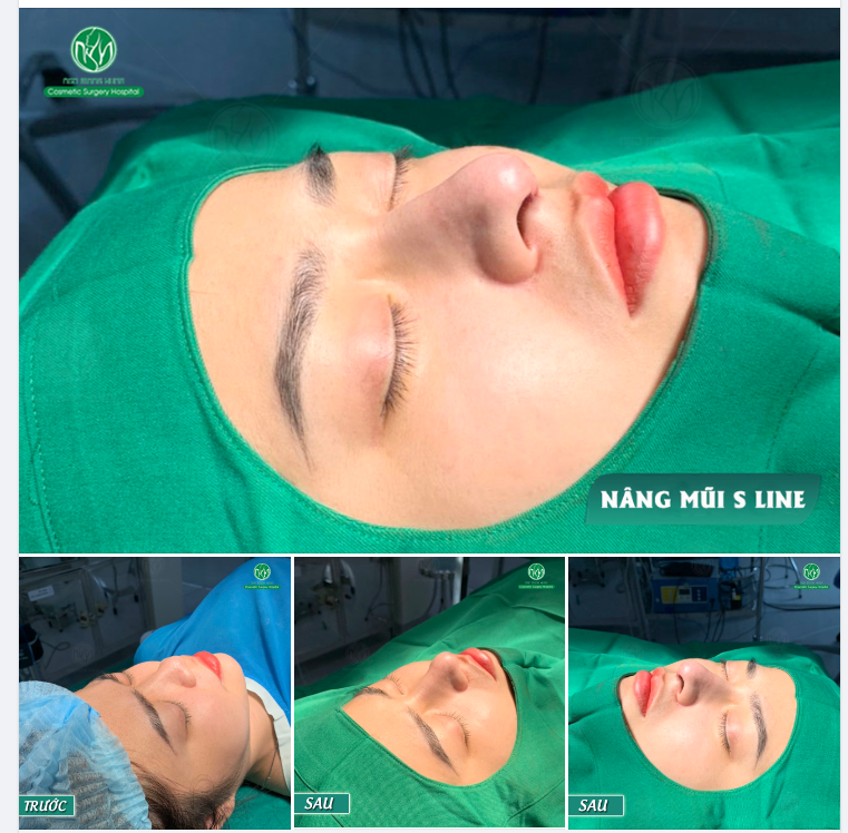 CẬN CẢNH FORM MŨI S LINE VẠN NGƯỜI MÊ