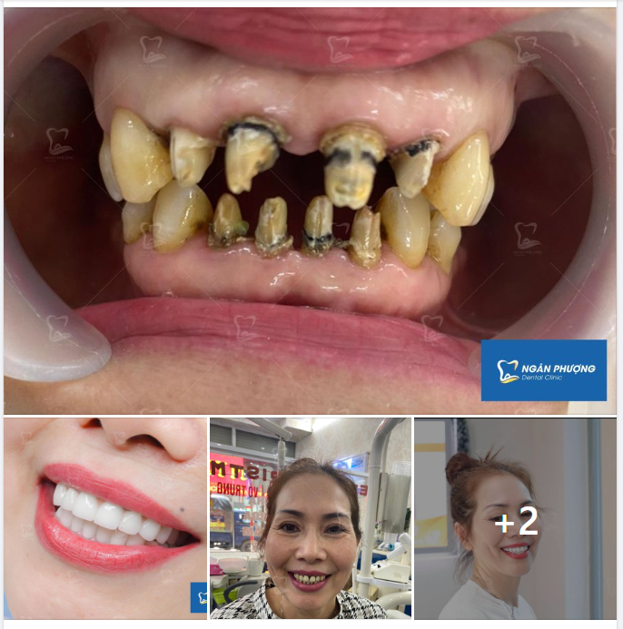 “Cấp cứu” nụ cười do làm sứ giá rẻ