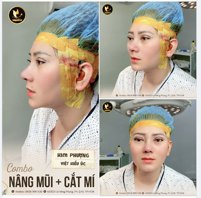CẶP ĐÔI NÂNG CẤP NHAN SẮC THẦN THÁNH NÂNG MŨI CẤU TRÚC KẾT HỢP CẮT MÍ CHO CHỊ KHÁCH VIỆT KIỀU ÚC