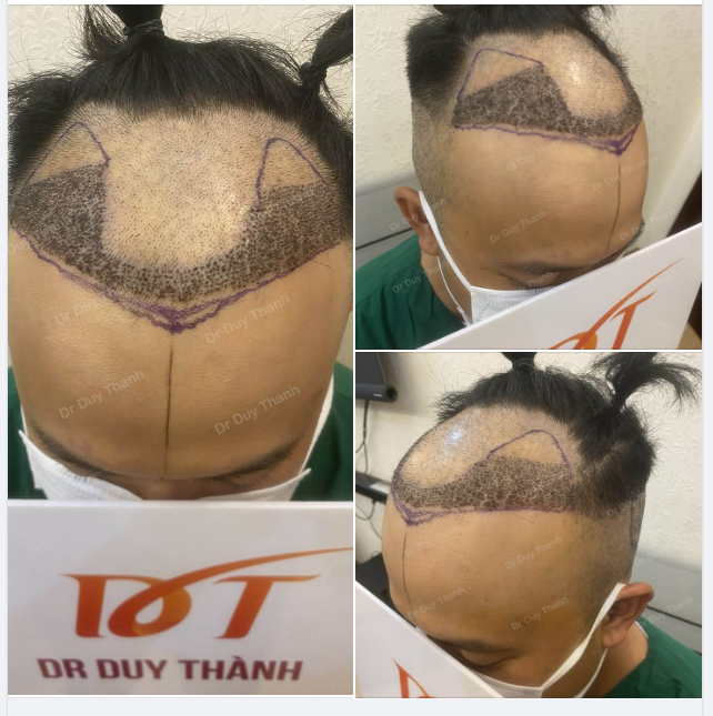 CASE 1 NGÀY HÔM NAY CẤY TIẾP 1100 NANG TÓC VÙNG ĐỈNH ĐẦU CHO KHÁCH NAM 32 TUỔI TỪ NHẬT BẢN