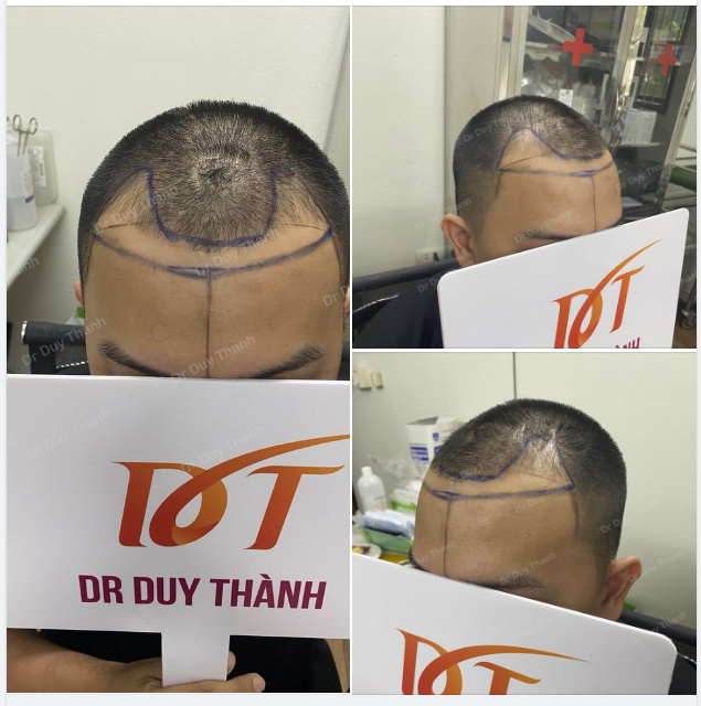 CASE 2 NGÀY HÔM NAY DỰ KIẾN CẤY 1750 NANG TÓC