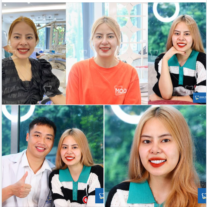 Cắt lợi rồi lại làm sứ, 1 tháng kiến tạo nụ cười duyên dáng