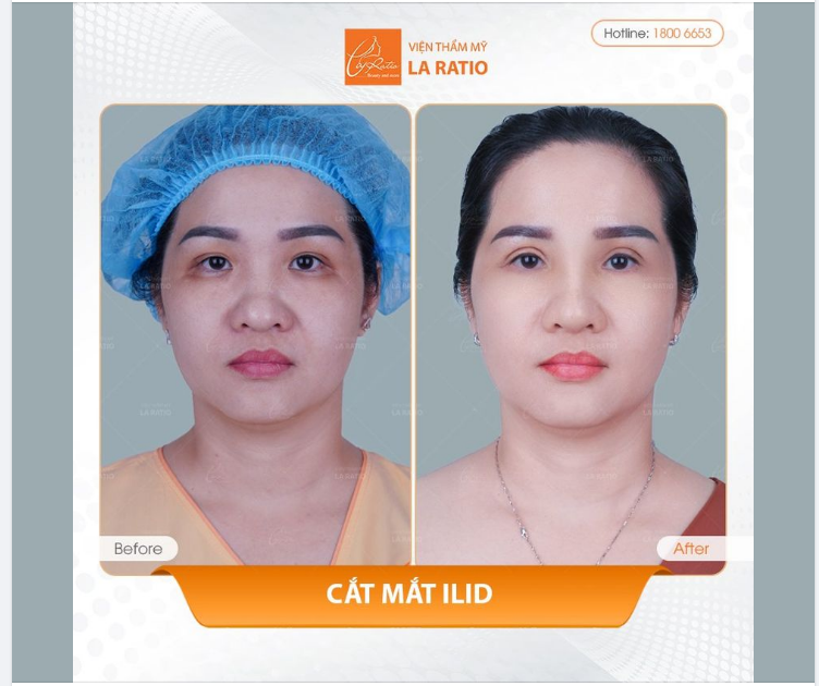 Cắt mắt iLid - Khắc phục toàn diện khuyết điểm mắt