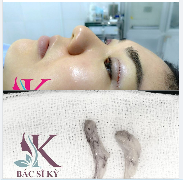 CẮT MẮT MÍ TRÊN PLASMA