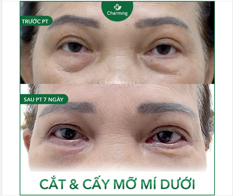 Cắt mí đi kèm lấy mỡ mí thì mọi người đã nghe nhiều rồi, nhưng cắt mí đi cùng cấy mỡ mí thì có vẻ hơi…sai sai