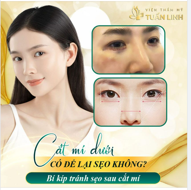 CẮT MÍ DƯỚI CÓ ĐỂ LẠI SẸO KHÔNG