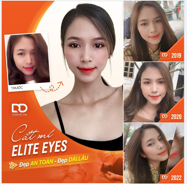 CẮT MÍ ELITE EYES - ĐẸP AN TOÀN, ĐẸP DÀI LÂU