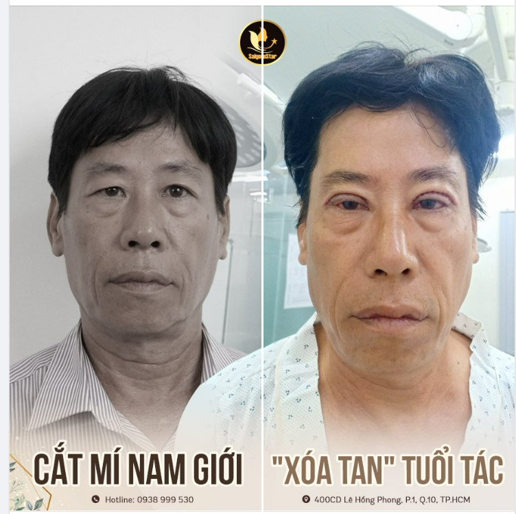 CẮT MÍ NAM GIỚI – “XÓA TAN” TUỔI TÁC KHI LÀM ĐẸP KHÔNG PHẢI LÀ ĐẶC QUYỀN CỦA NỮ GIỚI