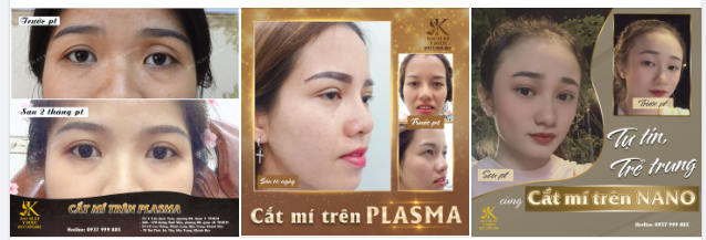 Cắt mí Nano  Plasma là phương pháp trẻ hóa mắt chuyên sâu hàng đầu