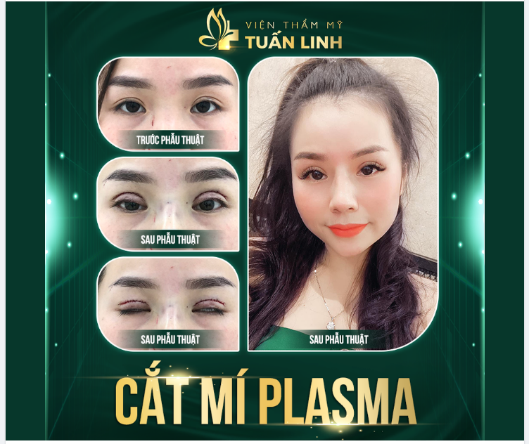 CẮT MÍ PLASMA - ÍT SƯNG ĐAU - HẠN CHẾ XÂM LẤN
