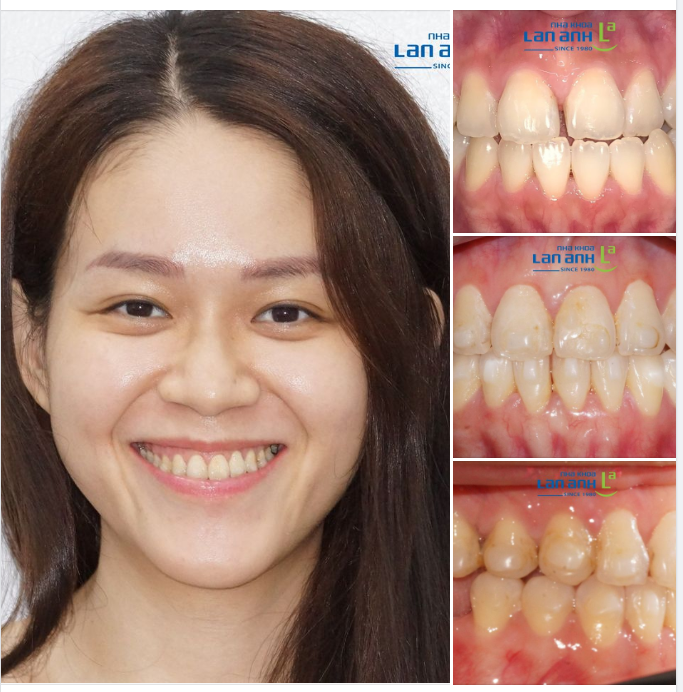 Câu chuyện bệnh nhân đã điều trị ung thư mong muốn được niềng răng.