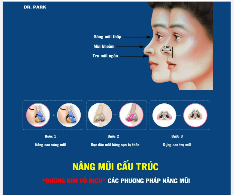 CẤU TRÚC - ĐƯƠNG KIM VÔ ĐỊCH CÁC PHƯƠNG PHÁP NÂNG MŨI