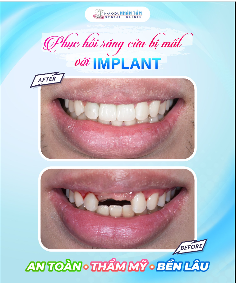 Cấy ghép Implant vùng răng cửa – Khó khăn và thách thức