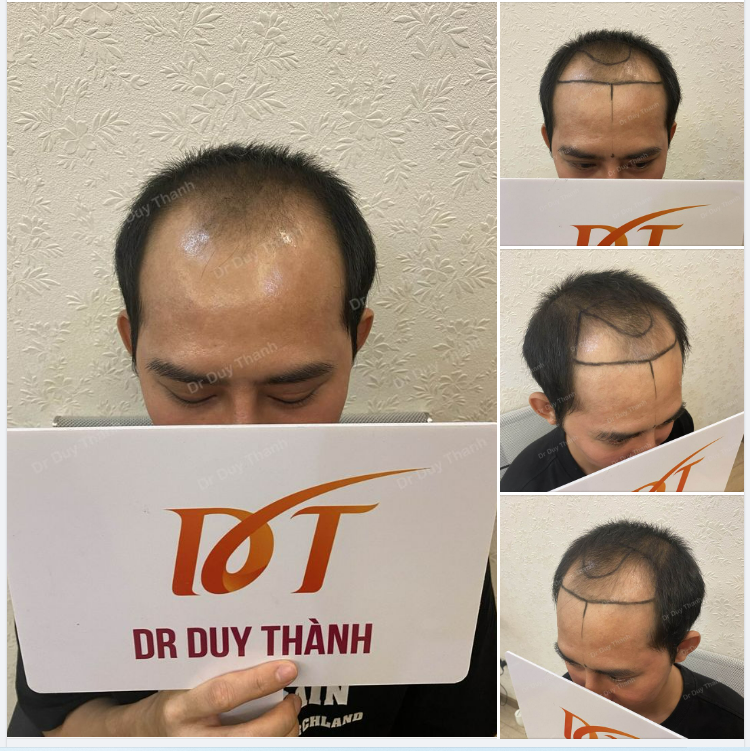 CẤY TÓC (PHIÊN 1) 2000 NANG CHO BOY NHA TRANG