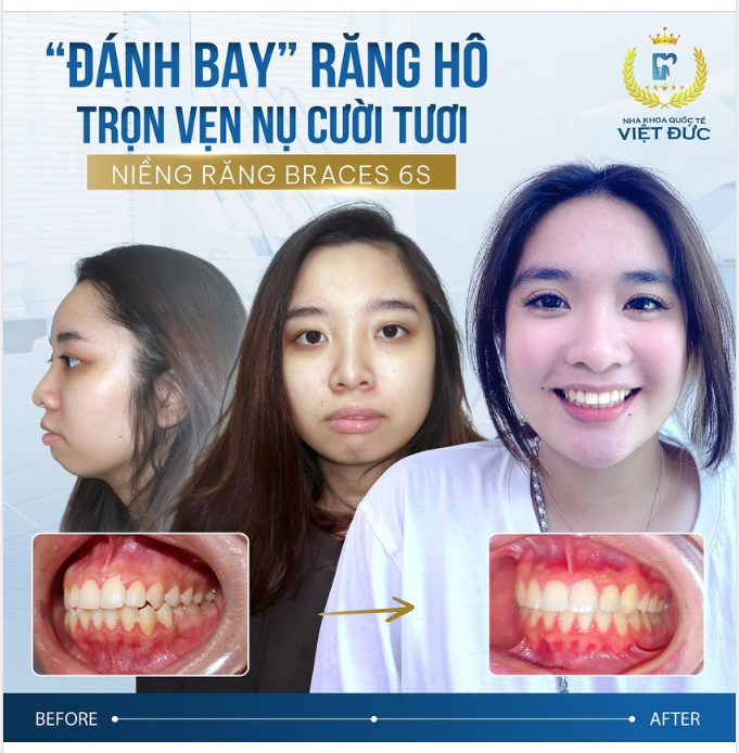 CHẲNG LO HÔ, MÓM NHỜ CÔNG NGHỆ NIỀNG RĂNG BRACES 6S HIỆN ĐẠI