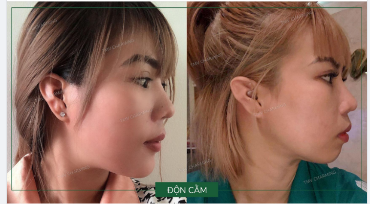 Charming thích tìm ảnh phẫu thuật nào nhất - Độn cằm