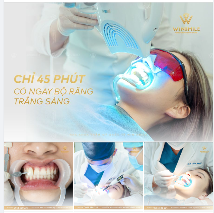 CHỈ 45 PHÚT CÓ NGAY HÀM RĂNG TRẮNG SÁNG