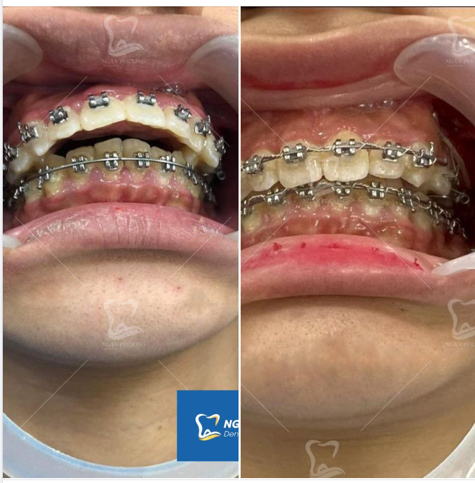 Chỉ cần 1 năm để hai hàm xích lại gần nhau