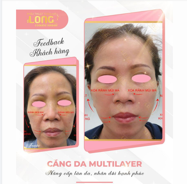 Chỉ cần bạn tin tưởng PTTM Bác sĩ Long, bạn chỉ cần đến trung tâm còn lại cứ để chúng tôi giúp bạn xinh đẹp đánh bật lão hóa dù bạn bao nhiêu tuổi cũng trẻ ra bất ngờ.