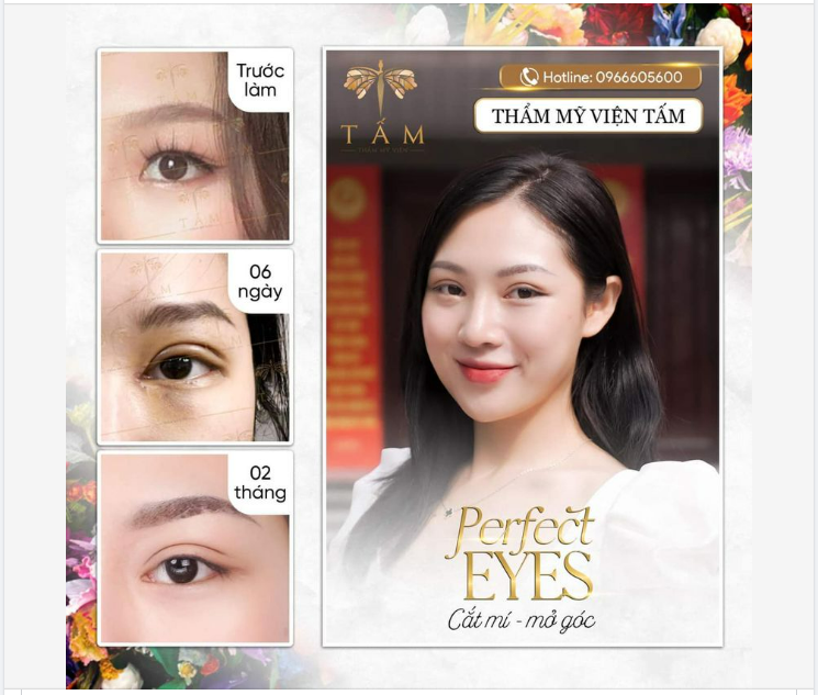 Chỉ sau 2 tháng thực hiện Combo Cắt mí - Mở góc trong, điều khách hàng nhận lại là gì