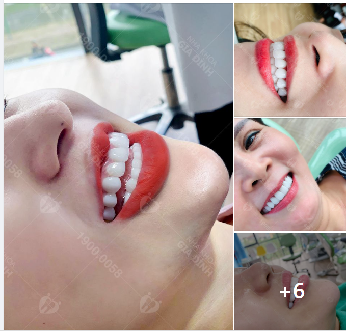 CHIÊM NGƯỠNG NHỮNG TUYỆT TÁC DO BÁC SĨ TẠI NHA KHOA GIA ĐÌNH THỰC HIỆN