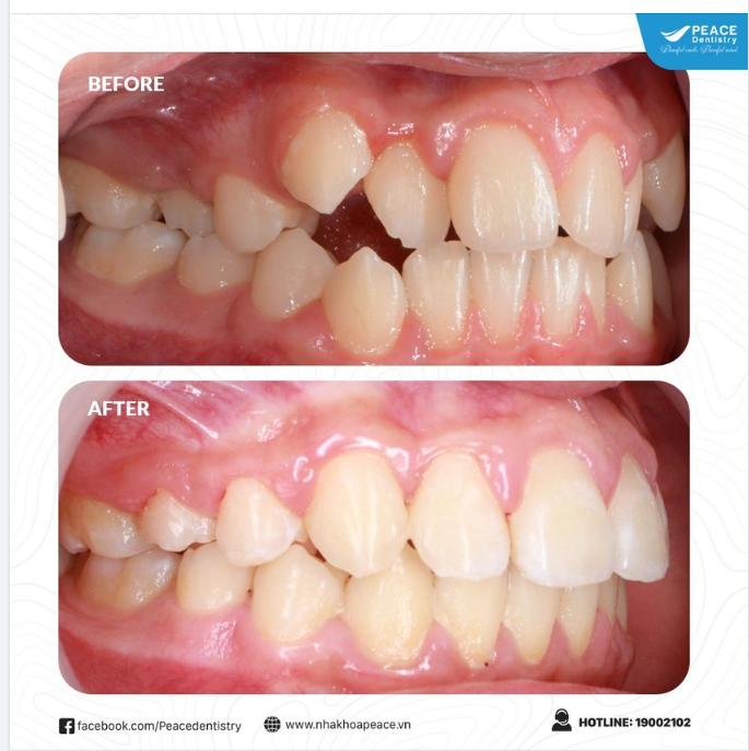 CHỈNH NHA TẠI PEACE DENTISTRY KHẮC PHỤC RĂNG CHEN CHÚC KHẤP KHỂNH