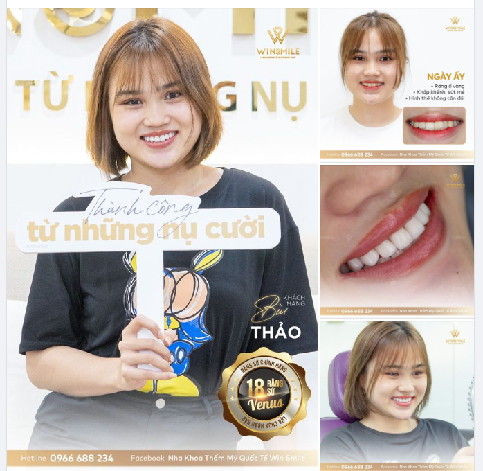 CHỌN RĂNG SỨ CHÍNH HÃNG SỬA MỌI KHUYẾT ĐIỂM NỤ CƯỜI