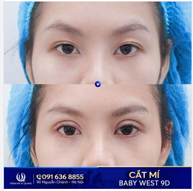 Chồng dẫn đi cắt mí - Món quà ý nghĩa ngày sinh nhật.