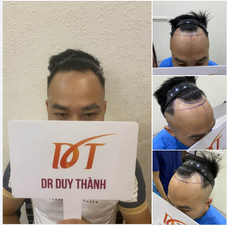 CHUẨN BỊ CẤY 1200 NANG TÓC CHO BOY NAM ĐỊNH 31 TUỔI