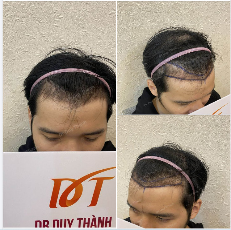 CHUẨN BỊ CẤY 1300 NANG TÓC CHO BẠN NAM MUỐN HẠ THẤP ĐƯỜNG CHÂN TÓC