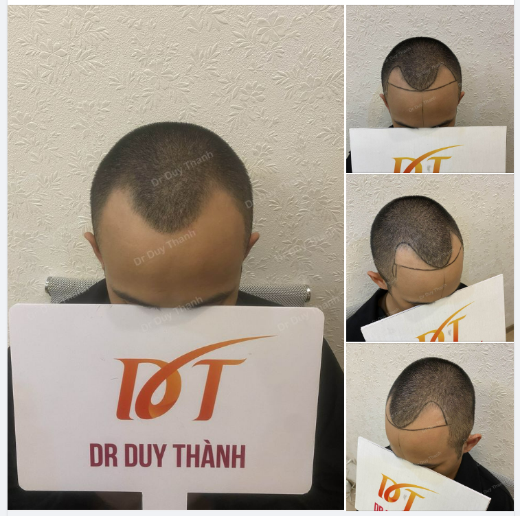 CHUẨN BỊ CẤY 1300 NANG TÓC KHẮC PHỤC HÓI CHỮ M CHO BOY THANH HÓA