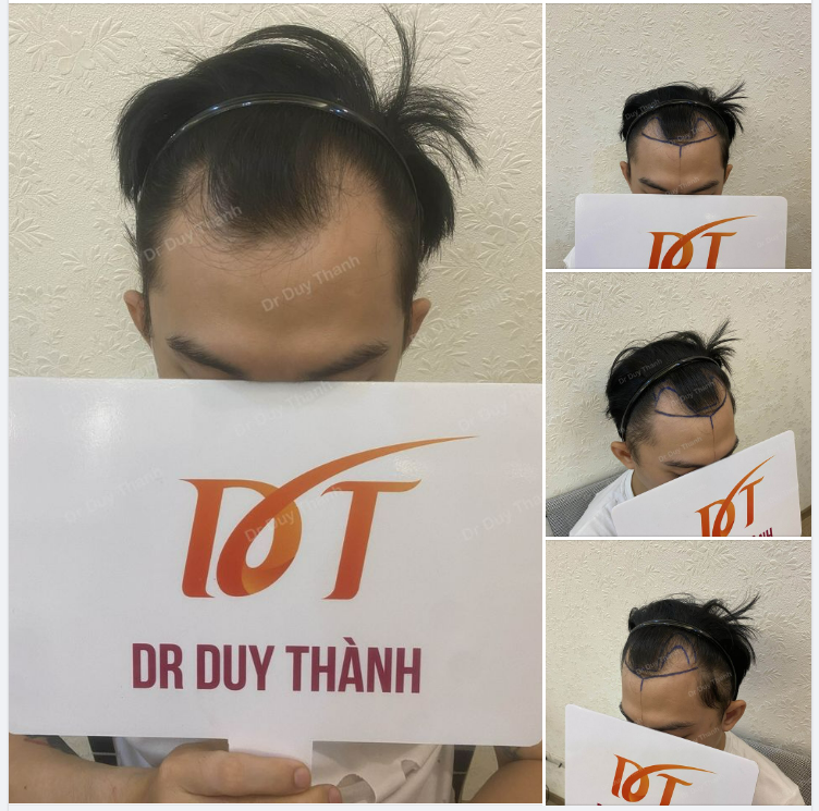 CHUẨN BỊ CẤY TÓC CHO BOY QUY NHƠN, DỰ KIẾN 1600 NANG