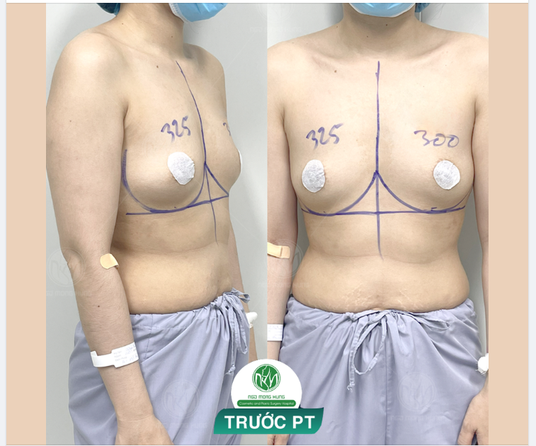 CHUẨN BỊ CHO MỘT CA NÂNG NGỰC ĐẶT TÚI 300-325CC