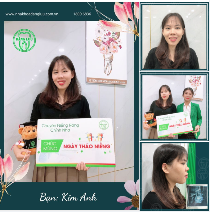 Chúc mừng Ngày tháo niềng