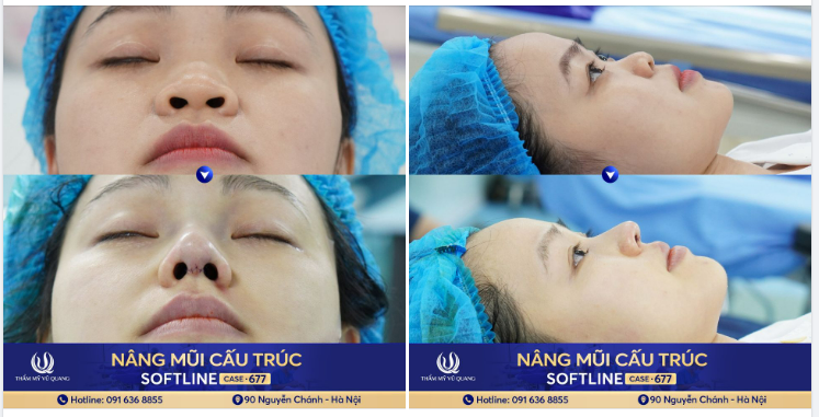 Cô giáo Tiếng Anh lột xác sau nâng mũi cấu trúc Softline