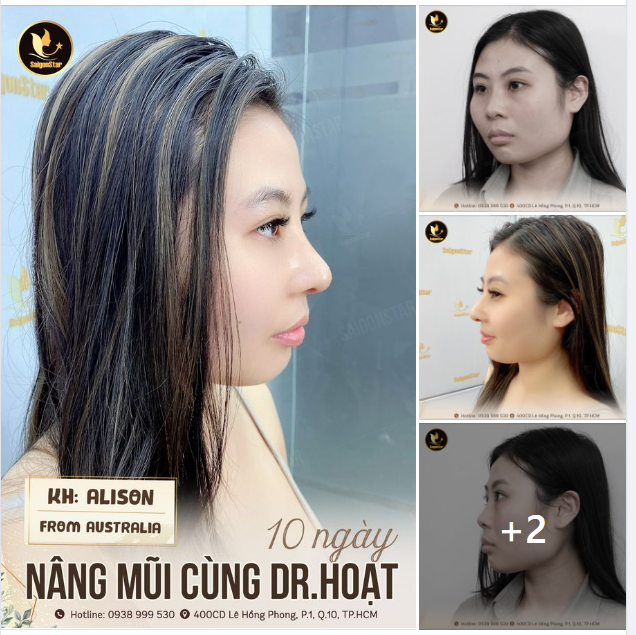CÔ NÀNG NGƯỜI ÚC LỘT XÁC THÀNH CÔNG CÙNG DR.HOẠT
